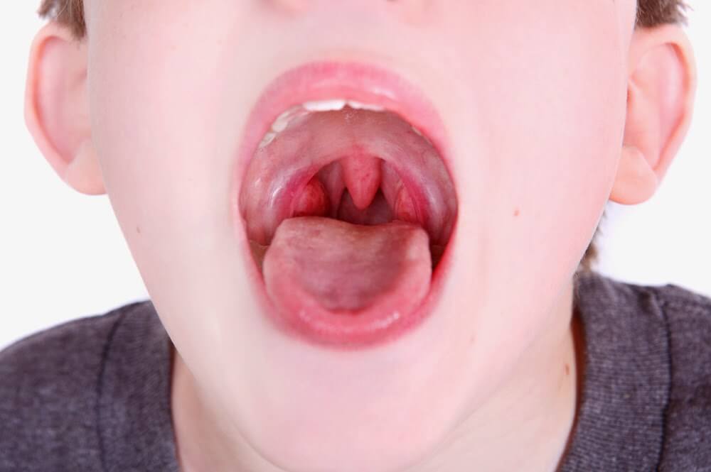 Viêm họng là bệnh thường gặp ở trẻ nhỏ